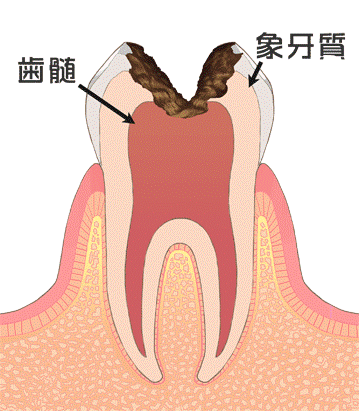 C4 歯根まで達したむし歯